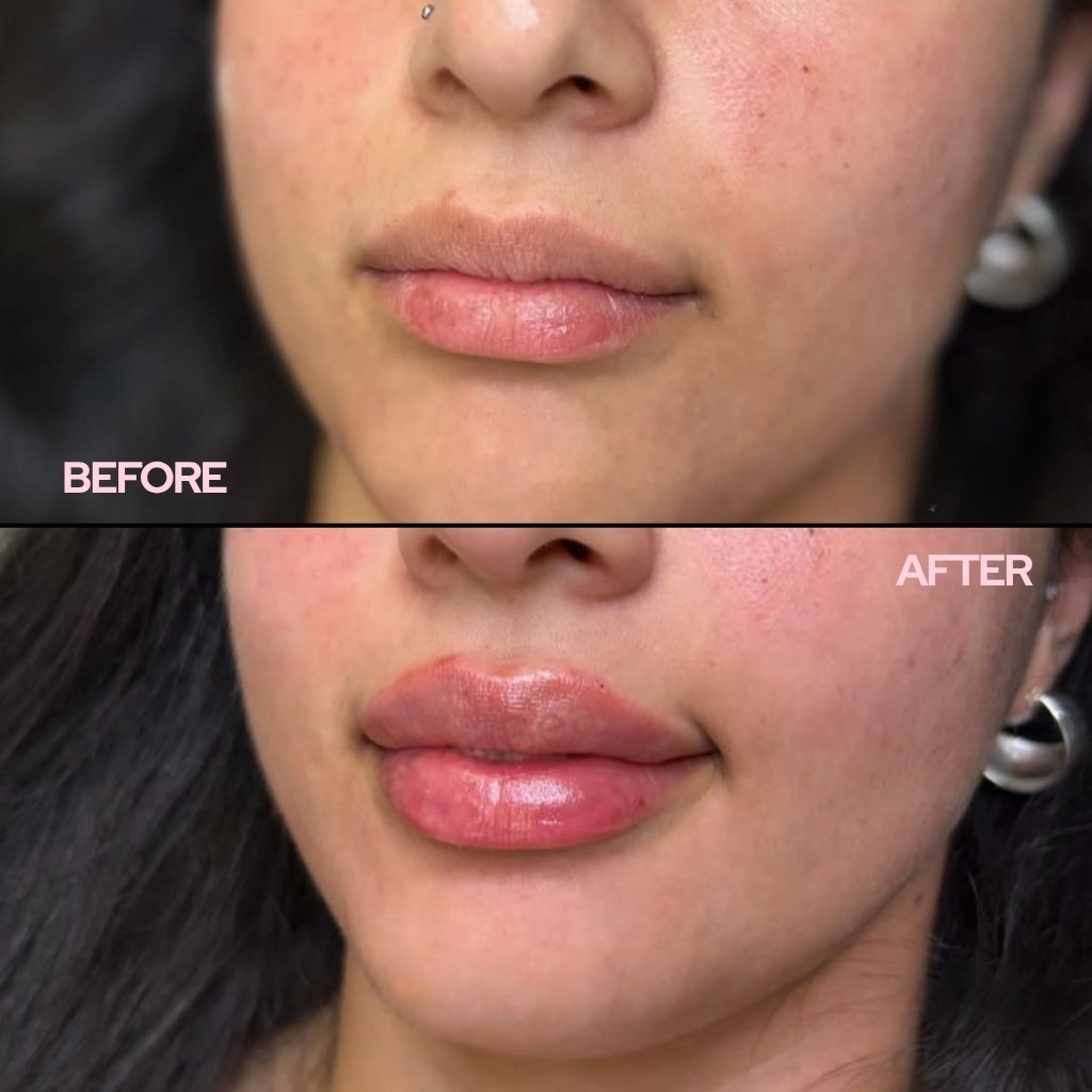 PinkLab™ Extreme Lip Plumper — 1+1 FREE